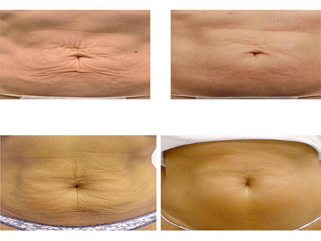 NON INVASIVE SKIN TIGHTENING