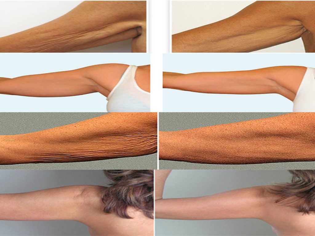 ARMS SCULPTING