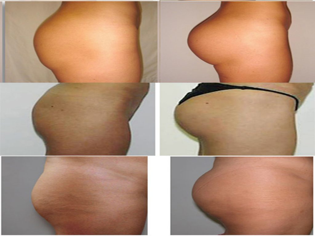 NON INVASIVE BUTT LIFT