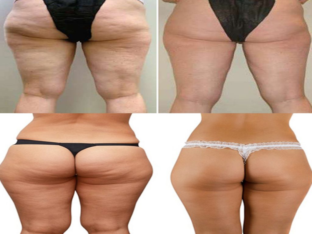 CELLULITE